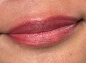after lip neutralization