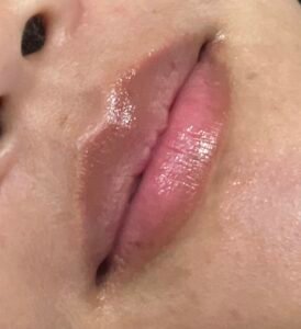 before neutralization